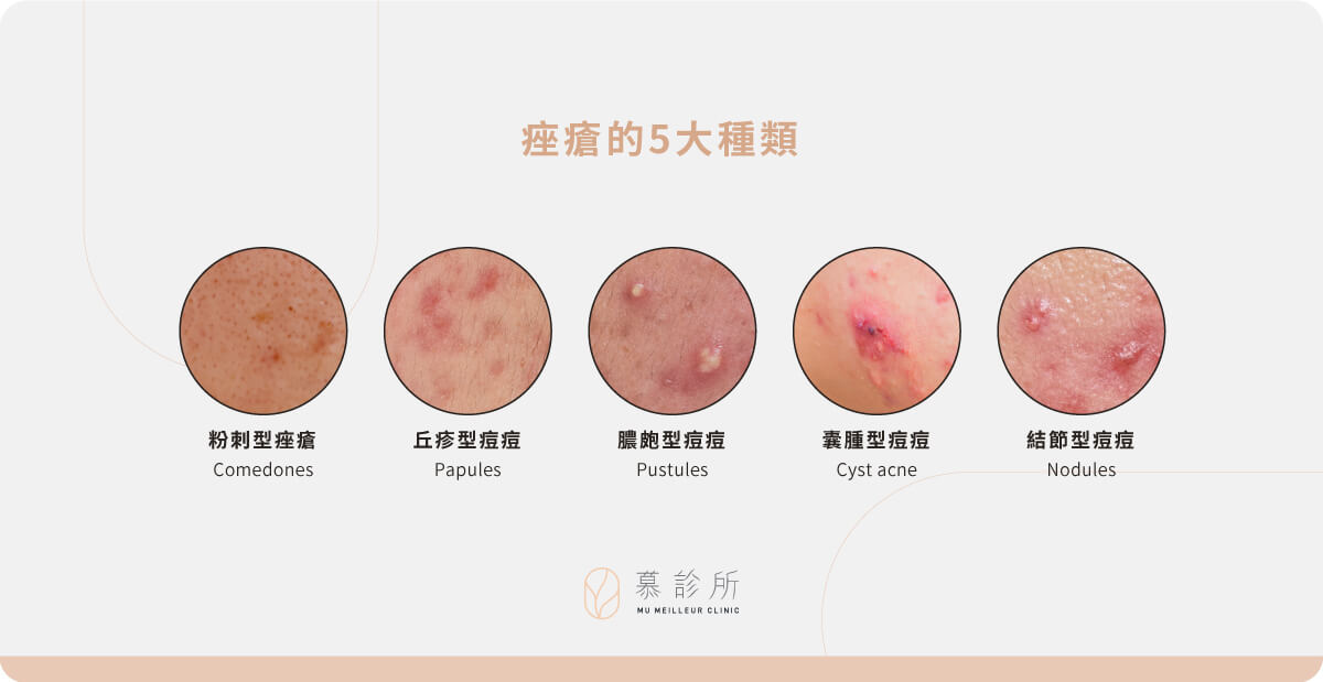 痘痘的成因與種類 |慕診所|痘痘治療 - 慕診所 Mu Meilleur
