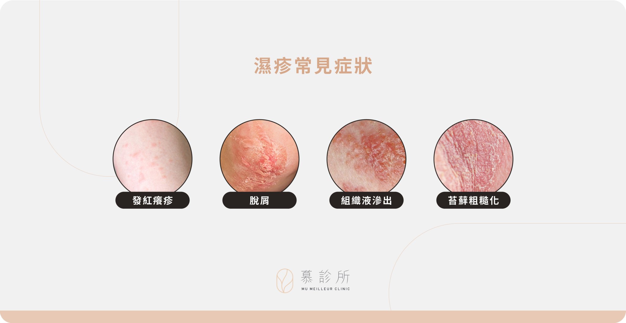 濕疹原因是什麼?反覆發作的原因是什麼?|慕診所|肌膚問題 - 慕診所 Mu Meilleur